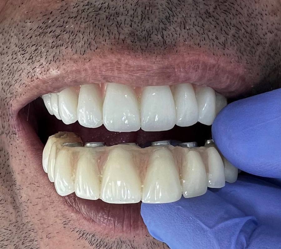Full Arch Zirconio CAD/CAM